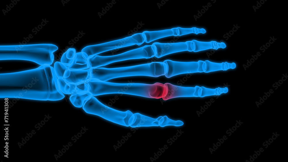X-ray hand
