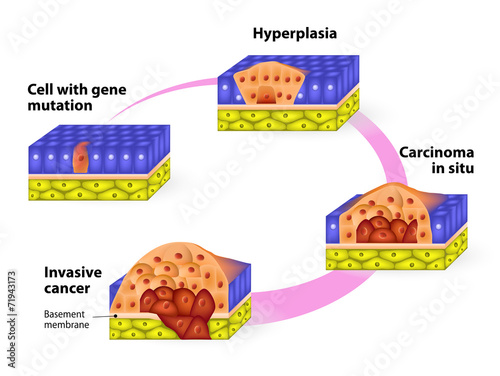 Developmental Phases of Cancer