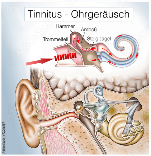 Tinnitus.Ohrensausen.Hörsturz photo
