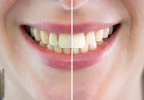 Denti prima e dopo sbiancamento photo