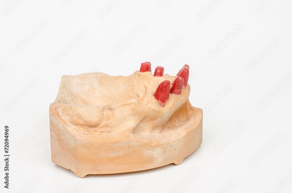 Oberkiefermodell mit Kunststoffstümpfen (seitlich) Oberkiefermodell mit Kunststoffstümpfen (seitlich)