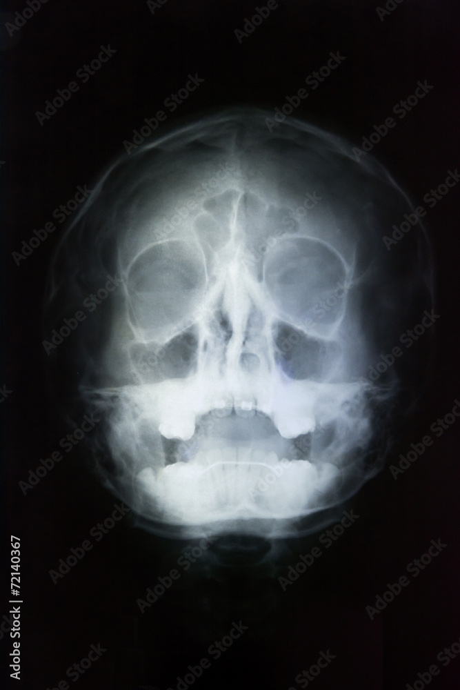human skull head x-ray human skull head x-ray