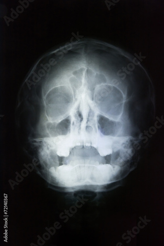 human skull head x-ray