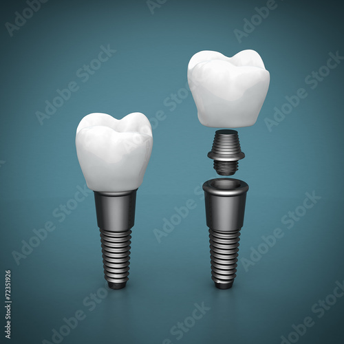 Dental implants