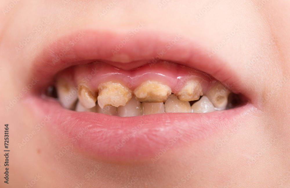 Fototapeta premium bad teeth