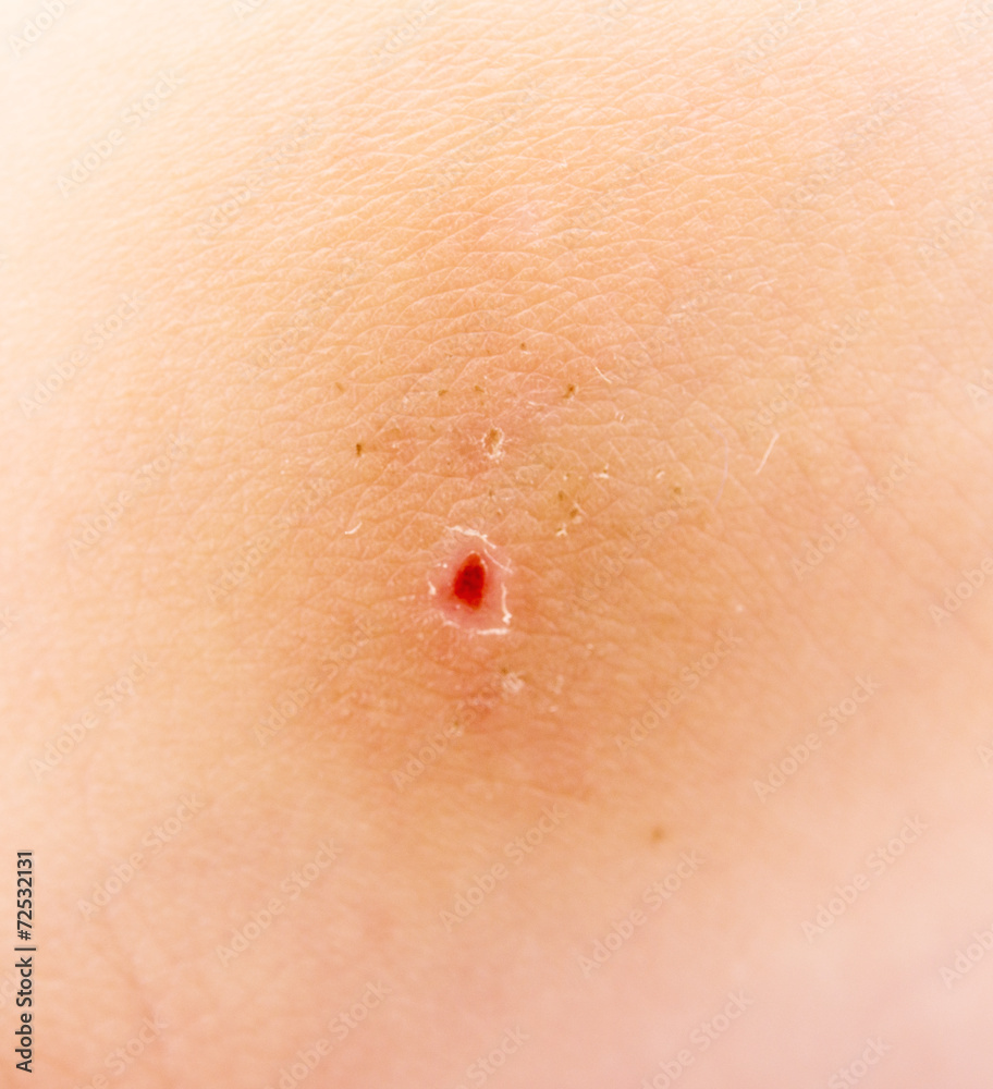 insect bite insect bite