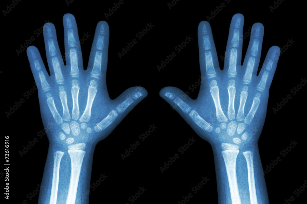 X-ray both child hands on black background X-ray both child hands on black background