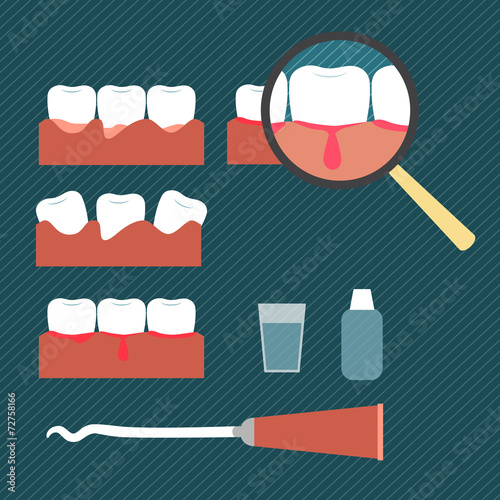 Illustration showing gum disease
