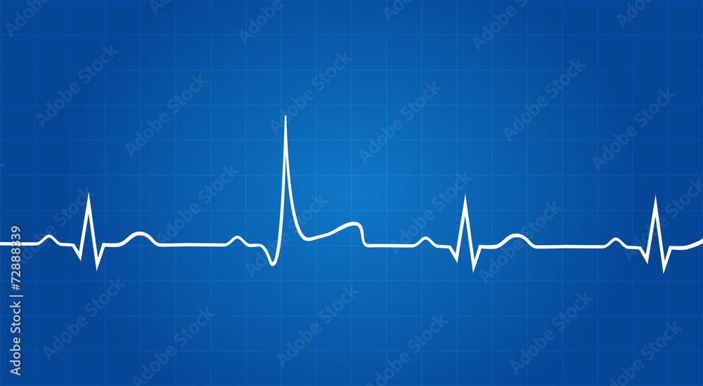 Naklejka premium Blueprint Of Heart Attack On Electrocardiogram