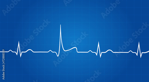 Blueprint Of Heart Attack On Electrocardiogram