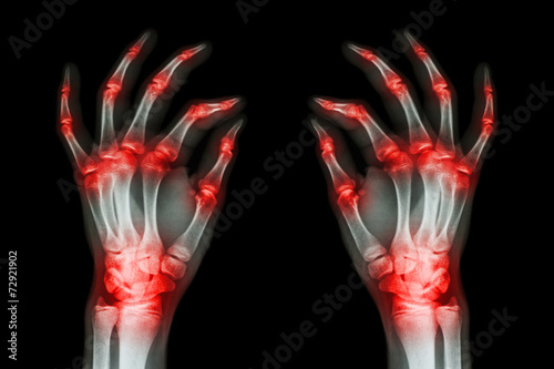 multiple joint arthritis both adult hands ( Gout , Rheumatoid ) photo
