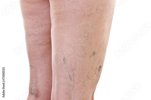 Legs with varicose veins