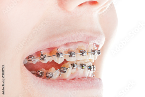 dental braces on teeth close up