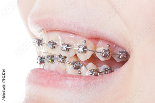 side view of dental braces on teeth close up