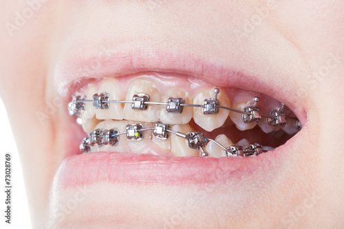 dental steel brackets on teeth close up