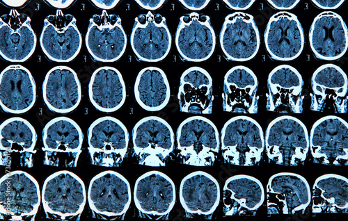 Mri Brain Scan