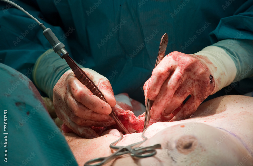 Surgeon operating in hospital Surgeon operating in hospital