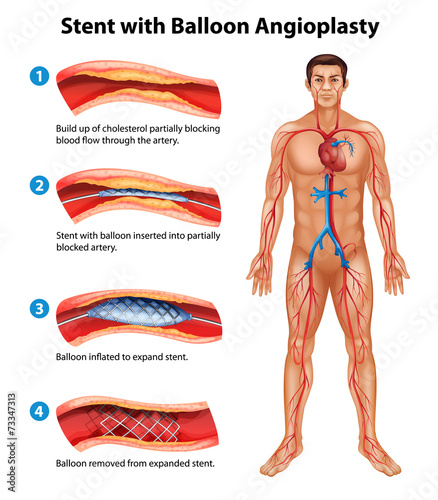 Stent angioplasty procedure