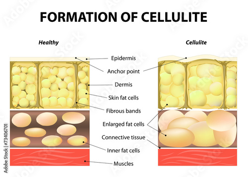 Formation of cellulite