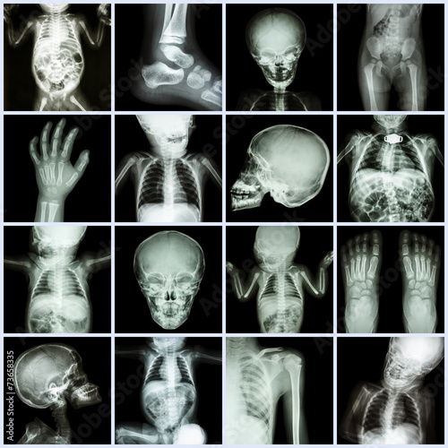 Collection X-ray part of child body