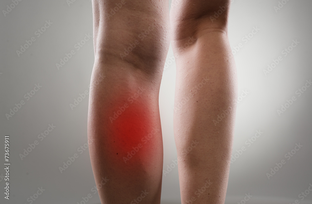 Injured female legs with red spots. Muscle strain and stretch Injured female legs with red spots. Muscle strain and stretch