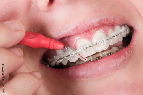 Zahnreinigung mit Zahnklammer