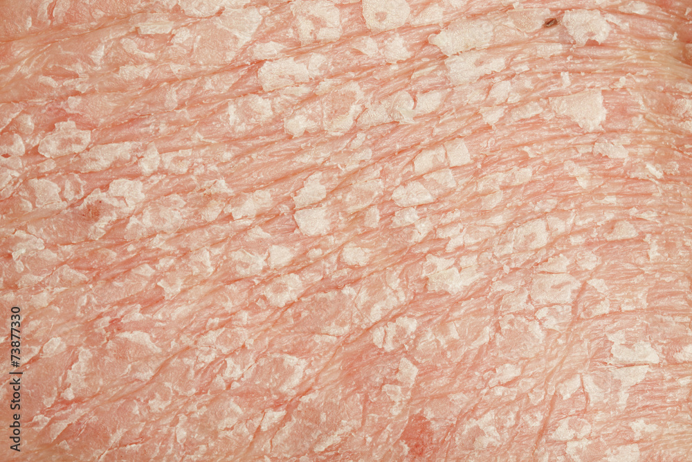 Fototapeta premium Psoriasis vulgaris is an autoimmune disease that affects the ski