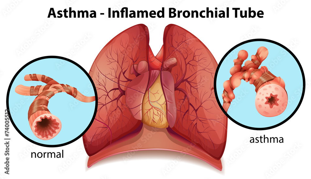 Αυτοκόλλητο An asthma-inflamed bronchial tube