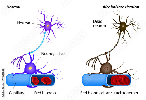 nerve damage caused by heavy alcohol intoxication