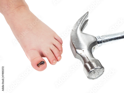 Child showing blue toenail barefoot and hammer head