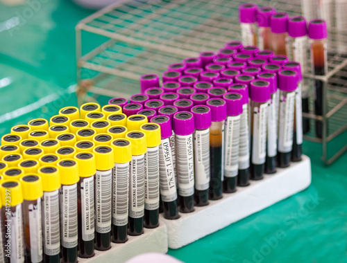 test tubes with blood on a tray