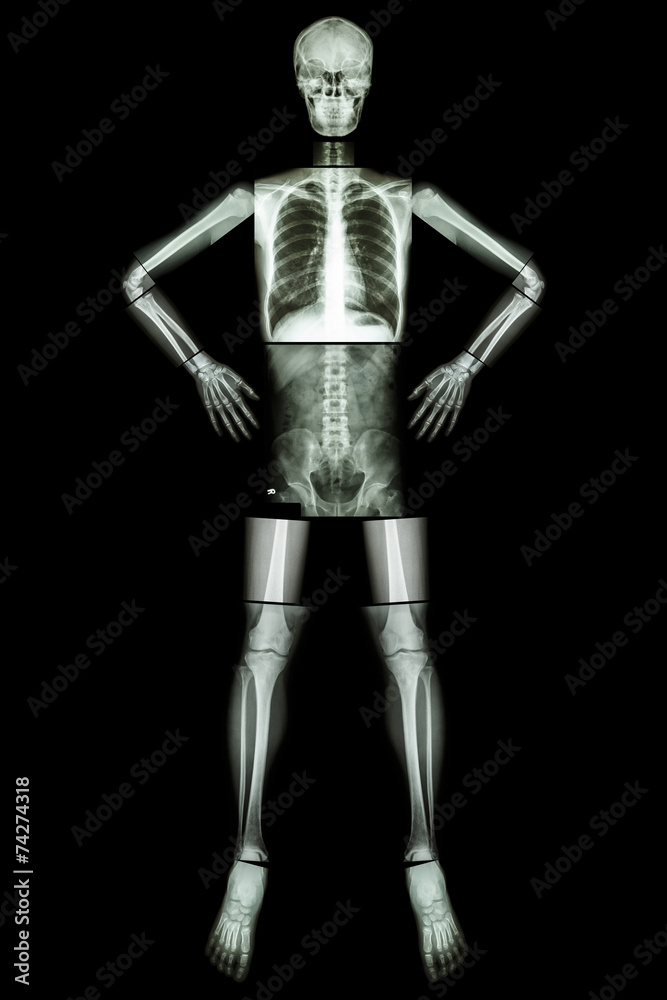 Human bone stand and akimbo ( X-ray whole body )