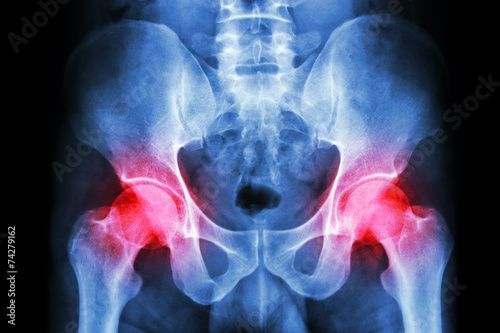 Wallpaper Mural human's pelvis and arthritis at both hip joint (Gout,Rheumatoid)