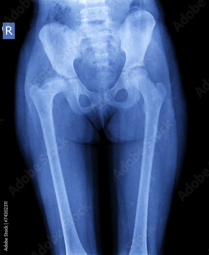 x-ray image of child hip