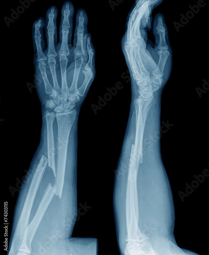 broken arm