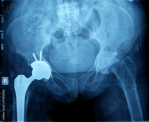 X-ray of the hip prosthesis