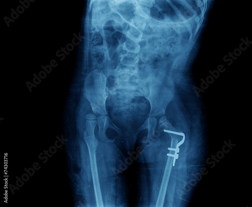 X-ray of the femur prosthesis photo