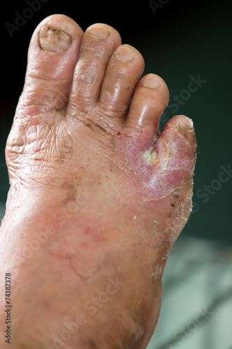 wound of diabetic foot © ittipol