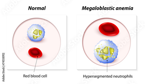 Megaloblastic anemia photo
