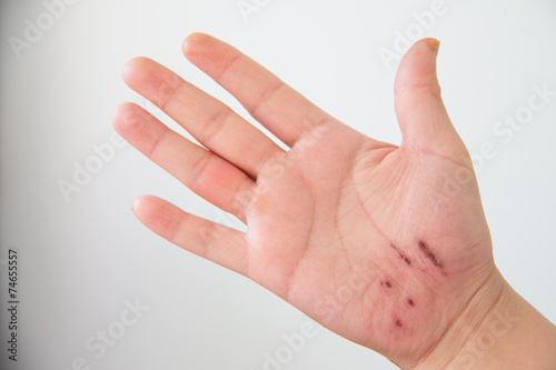 Injured hand