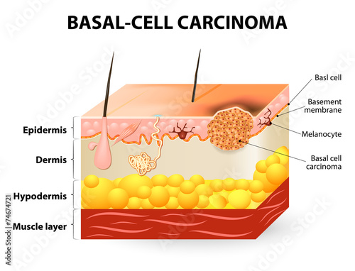 Basal-cell carcinoma or basal cell cancer