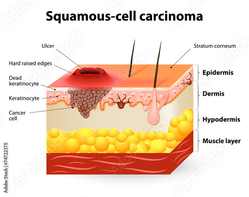 Squamous cell carcinoma photo