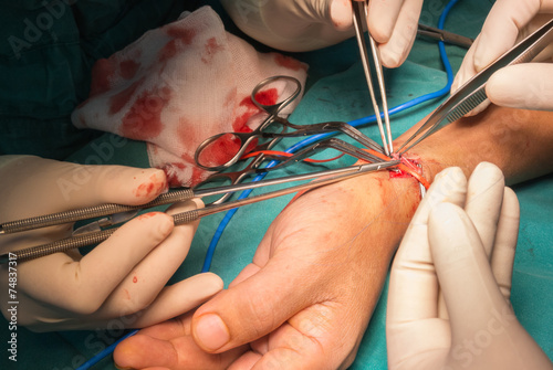 arteriovenous fistula operation for dialysis photo