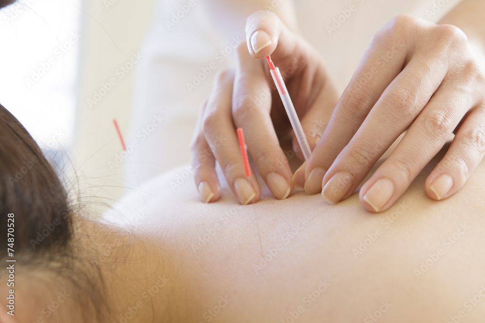 Naklejka premium Woman undergoing acupuncture