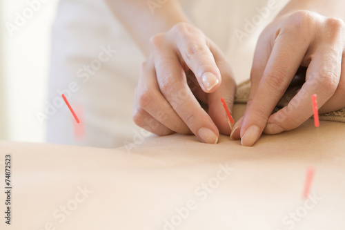 Women undergoing acupuncture waist