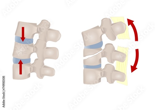 vari tipi di frattura vertebrale photo