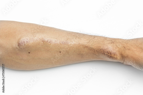 Hemodialysis blood vessel for renal insufficiency
