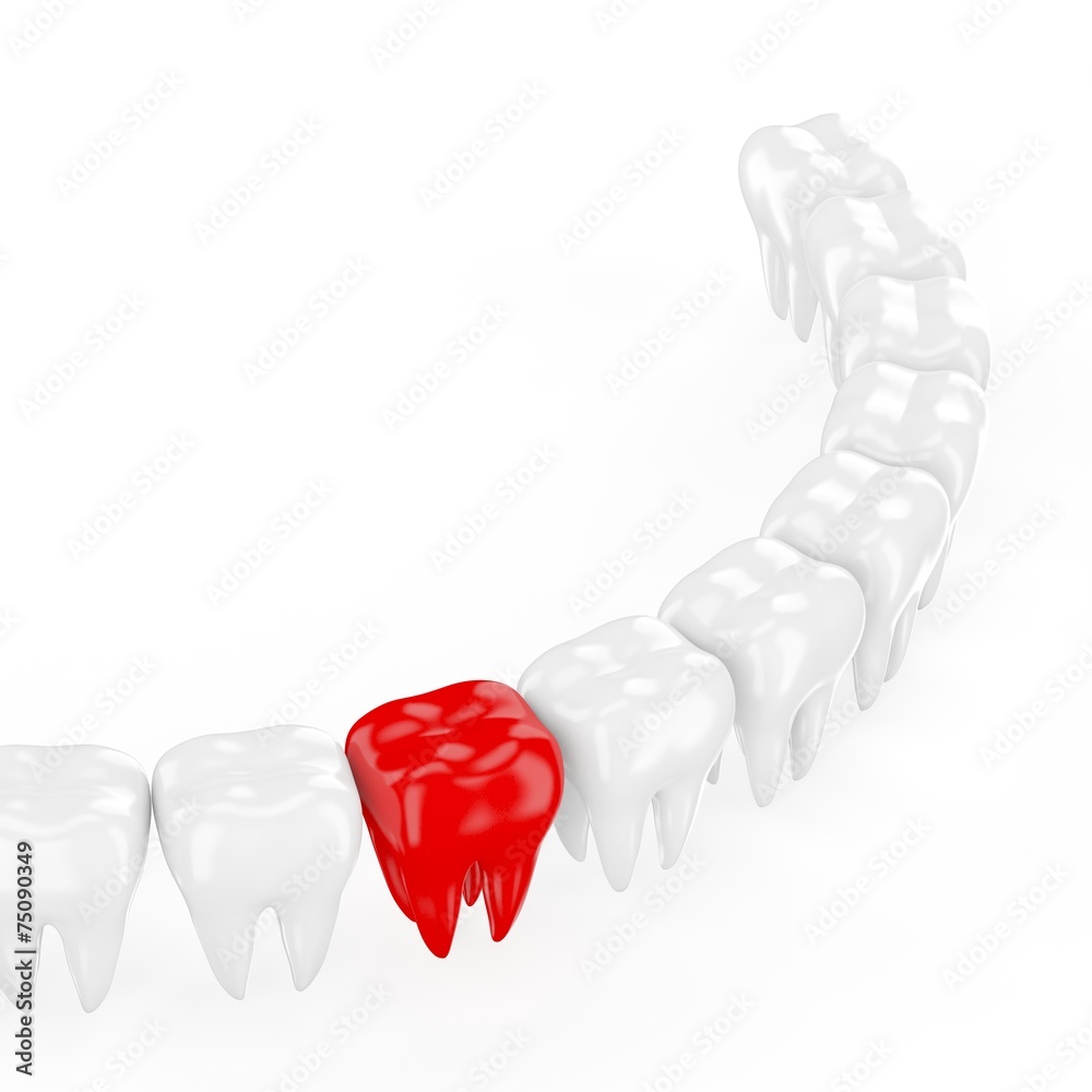 Aching tooth in row of healthy teeth. 3d