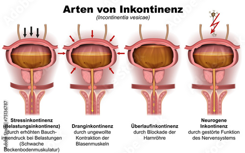 Arten von Inkontinenz, Urologie