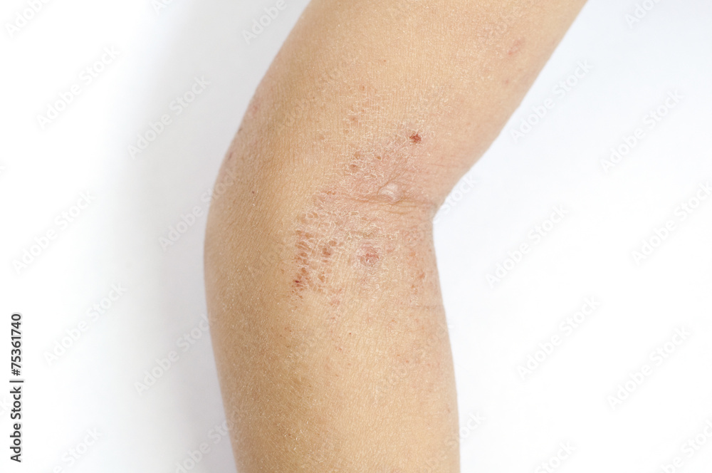 Eczema Eczema